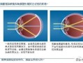 什么是特殊角膜接触镜，什么是特殊角膜接触镜的作用